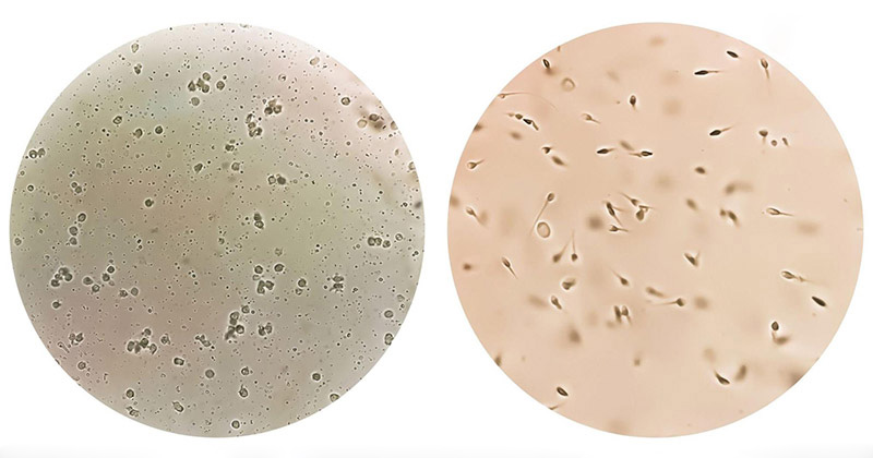 tinh trùng kém di động sẽ làm ảnh hưởng đến khả năng sinh sản của nam giới