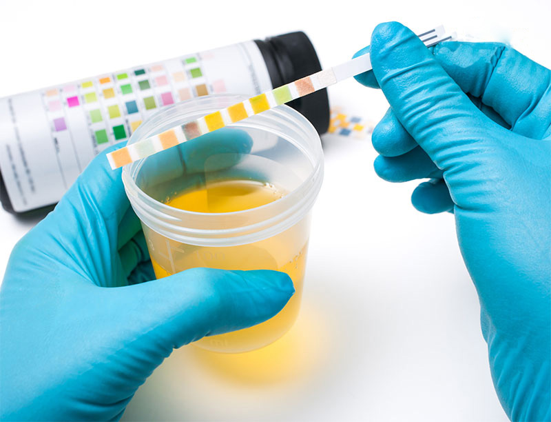 nếu bị xuất tinh ngược, tinh dịch sẽ được tìm thấy trong nước tiểu sau khi thủ dâm