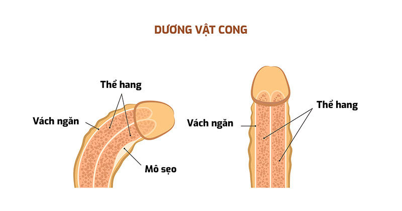 Cong dương vật xảy ra do các mảng xơ hoặc cục xơ cứng phát triển ở giữa 2 lớp áo của dương vật