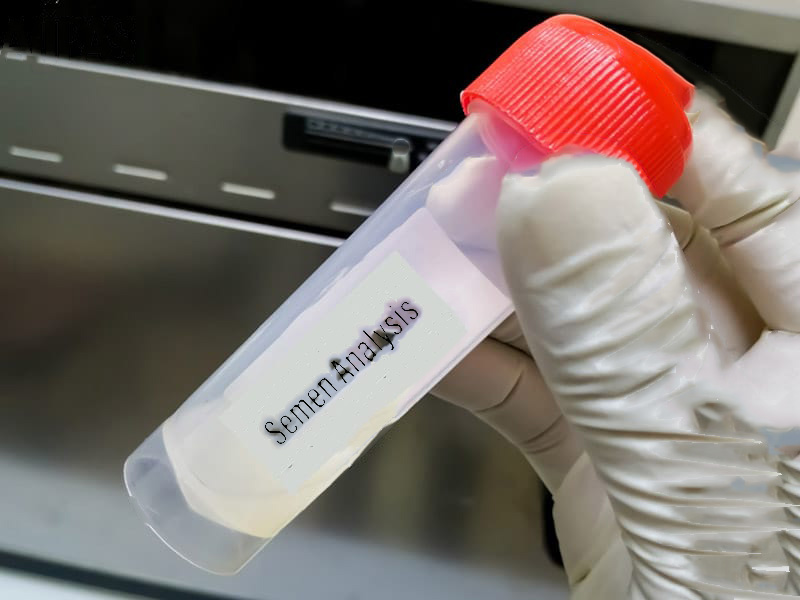 mẫu tinh dịch sẽ được phân tích trong máy ly tâm hoặc soi dưới kính hiển vi để chẩn đoán chính xác mẫu tinh dịch sẽ được phân tích trong máy ly tâm hoặc soi dưới kính hiển vi để chẩn đoán chính xác