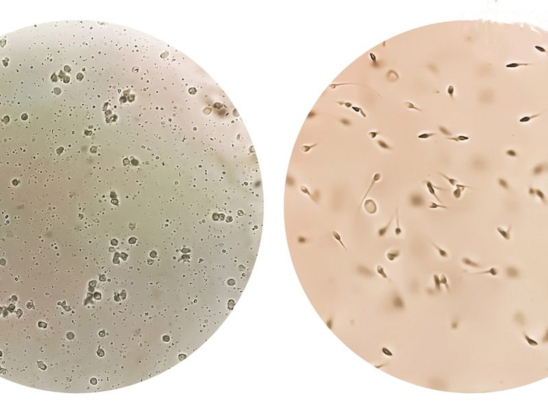 chứng vô tinh nghĩa là không tìm thấy tinh trùng trong tinh dịch chứng vô tinh nghĩa là không tìm thấy tinh trùng trong tinh dịch