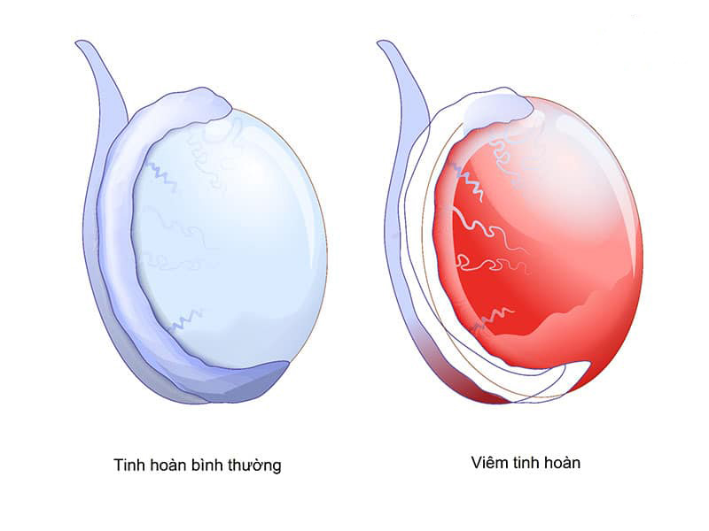 Viêm tinh hoàn ảnh hưởng nhiều đến chất lượng đời sống tình dục của nam giới