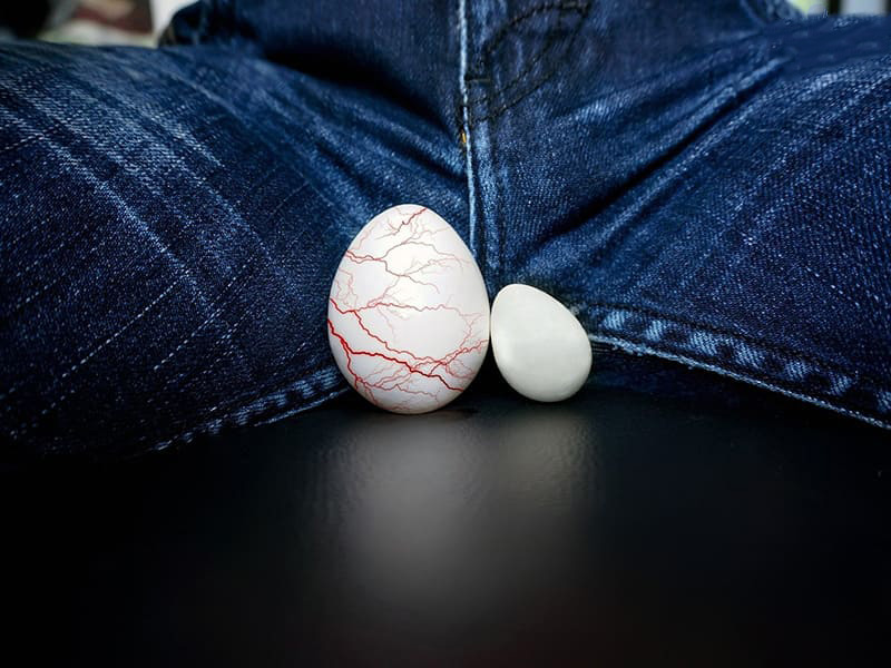 giãn tĩnh mạch thừng tinh có ảnh hưởng đến số lượng tinh trùng khi xuất tinh