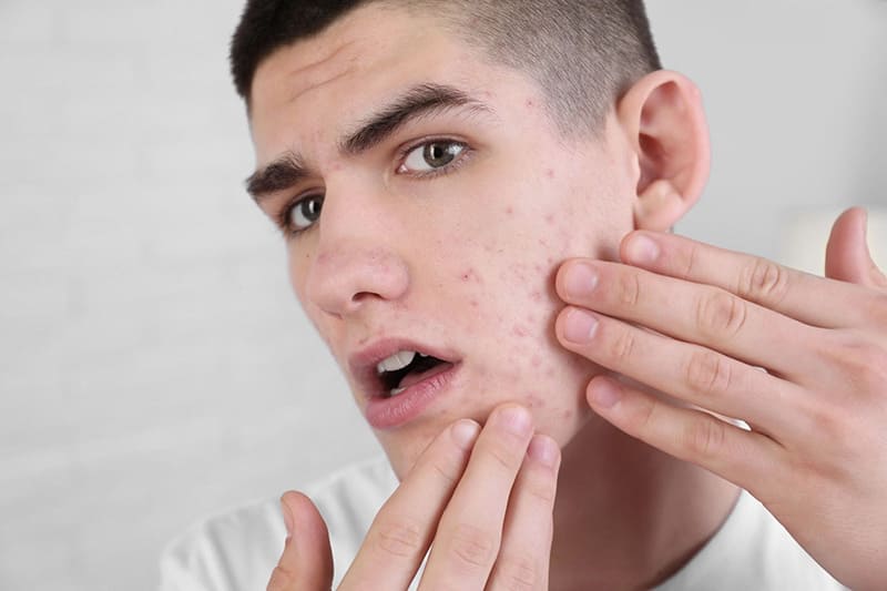 có thể bị mụn trứng cá sau khi dùng protein bổ sung
