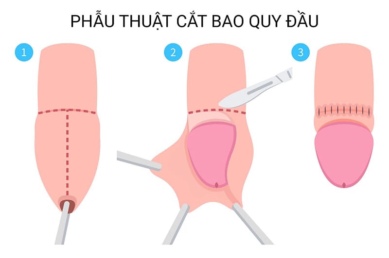là loại tiểu phẫu phổ biến ở nam giới