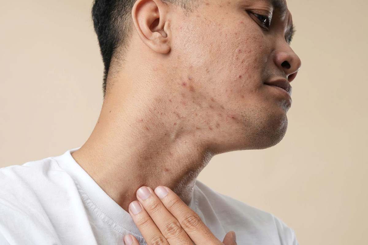 có thể biểu hiện bằng mụn trứng cá